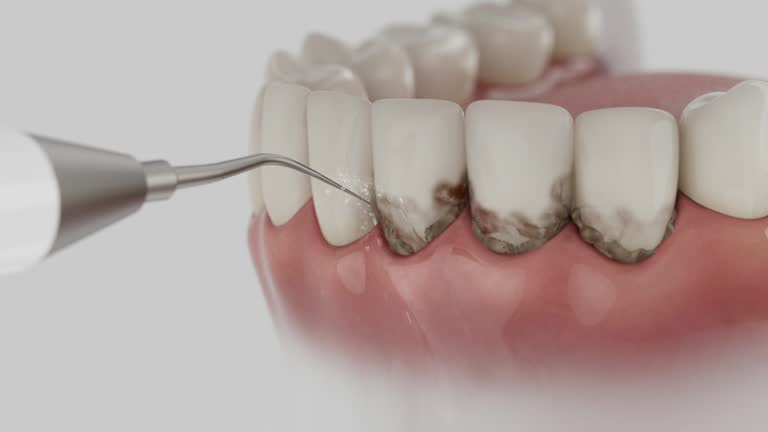 Trusted Wisdom Tooth Removal service in Waynesville, NC - Dentist Open Now